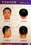 Series Chart of Acupuncture: Head Needle