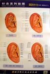 Series Chart of Acupuncture: Ear Needle