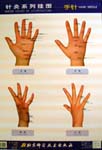 Series Chart of Acupuncture: Hand Needle